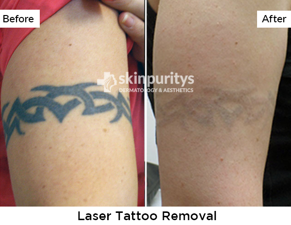 Laser Tattoo Removal results